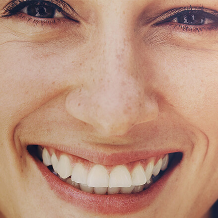 veneers