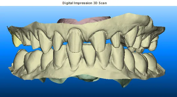 A 3D digital model rendering of a patient's upper and lower dental arches created from a 3D impression scan.