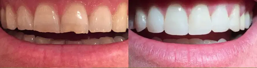Side-by-side close-up comparison of a patient's upper teeth showing a chipped front tooth before and a restored, white smile after.