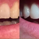 Side-by-side close-up comparison of a patient's upper teeth showing a chipped front tooth before and a restored, white smile after.