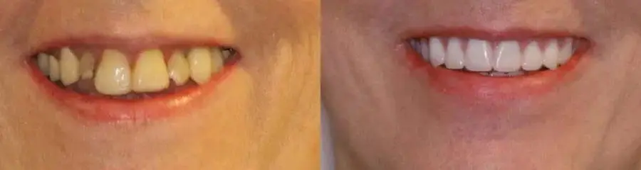 Side-by-side smile comparison showing misaligned and discolored upper teeth before treatment and a straight, bright white smile after.