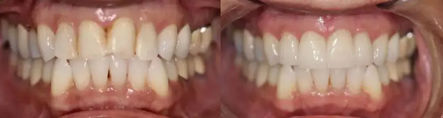 Side-by-side close-up view of upper and lower teeth before and after a dental whitening or restorative procedure.