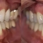 Side-by-side close-up view of upper and lower teeth before and after a dental whitening or restorative procedure.