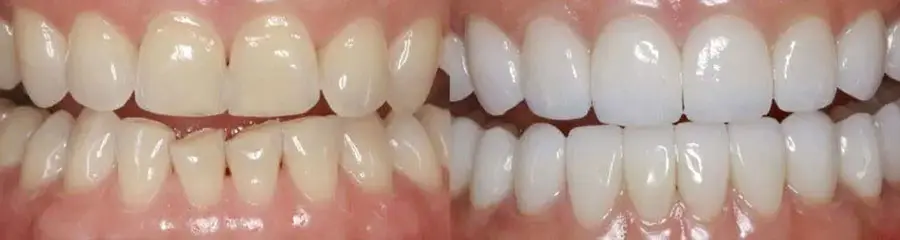 Side-by-side close-up view of teeth showing improved alignment and shade enhancement after cosmetic dental treatment.