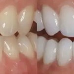 Side-by-side close-up view of teeth showing improved alignment and shade enhancement after cosmetic dental treatment.