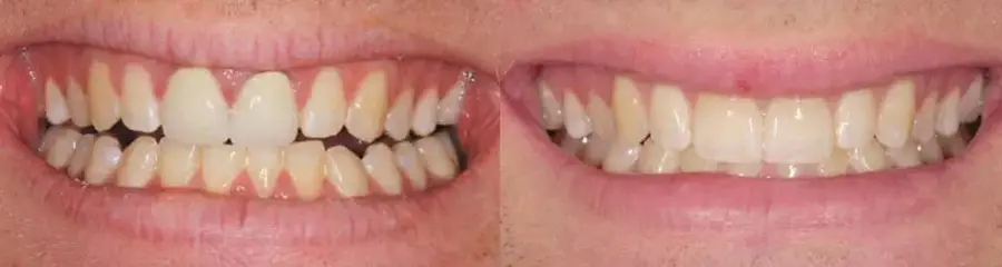 Side-by-side comparison showing a worn, yellowed smile before treatment and a full set of straight, bright white teeth after.