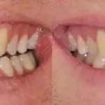 Side-by-side comparison showing a worn, yellowed smile before treatment and a full set of straight, bright white teeth after.