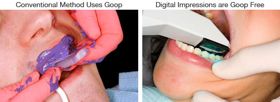 Side-by-side comparison illustrating a messy conventional gel impression method on the left versus a clean digital intraoral scanner on the right.